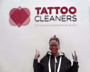 ¿Buscas ideas de negocio exitosas? Monta una empresa de eliminación de tatuajes como Tattoo Cleaners